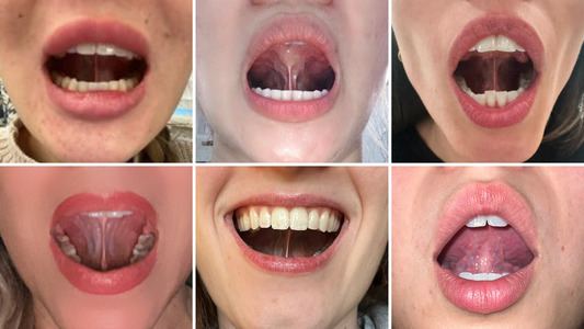 Thumbnail for 'Exploring the Role of the Tongue in Facial Development', delving into how proper tongue posture can influence the growth and structure of the face.