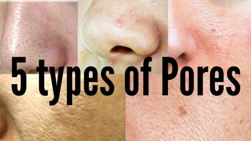 5 Types of Pores