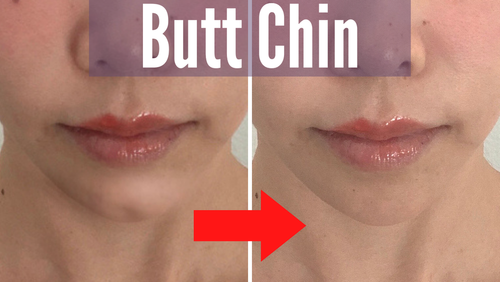 Thumbnail for 'Relax Butt Chin', showcasing methods and exercises to relax and smooth the chin area, often referred to as the 'butt chin'.