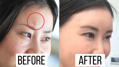 Thumbnail for 'Eliminate 11th Frown Lines Between Eyebrows', detailing exercises and skincare methods to smooth out the deep lines for a relaxed and rejuvenated facial expression.