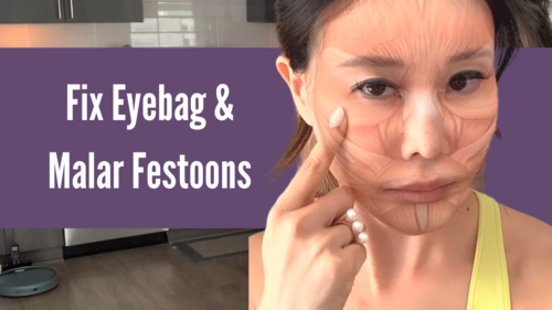 Why Eyebag (Incl Malar Festoon Bags) Occurs | Wake Up Sleeping Muscles To Lift Up The Skin