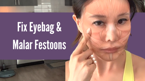 Thumbnail for 'Why Eyebags (Including Malar Festoon Bags) Occur', explaining the causes behind the formation of under-eye and malar festoon bags and discussing preventative and treatment options.