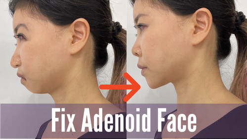 What is Adenoid Face How to Improve | Koko Face Yoga