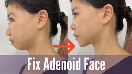 Thumbnail for a blog post titled 'What Is Adenoid Face & How To Improve', providing insights into the characteristics of adenoid facies and tips for enhancing facial structure and health.