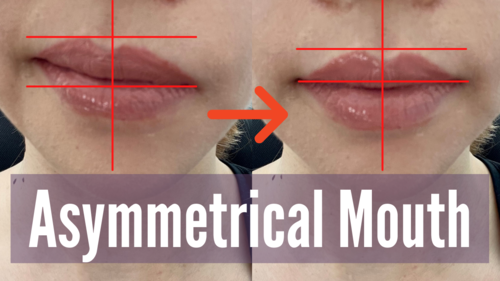 Thumbnail for a blog post titled 'Fix Asymmetrical Mouth and Lips', offering guidance on correcting unevenness in the mouth and lip area through exercises, makeup techniques, and possibly medical interventions for a more symmetrical appearance.