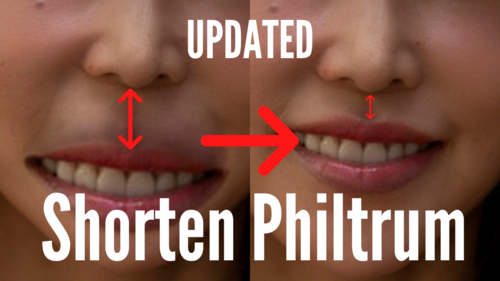 Thumbnail for 'Shorten Philtrum By Activating Exercise', featuring exercises aimed at reducing the length of the philtrum for enhanced facial proportions.