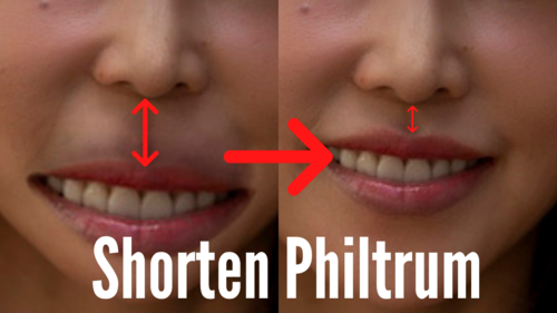 Thumbnail for 'Shorten Philtrum', featuring techniques and exercises aimed at reducing the length of the philtrum for improved facial proportions.