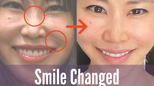 Smile changed
