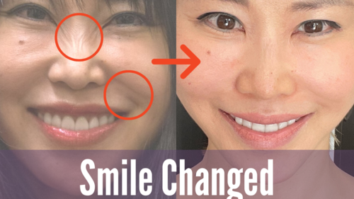 Thumbnail for a blog post titled 'Smile Changed', showcasing before and after comparisons of smiles transformed through facial exercises, dental care, or cosmetic procedures, highlighting the impact on appearance and confidence.