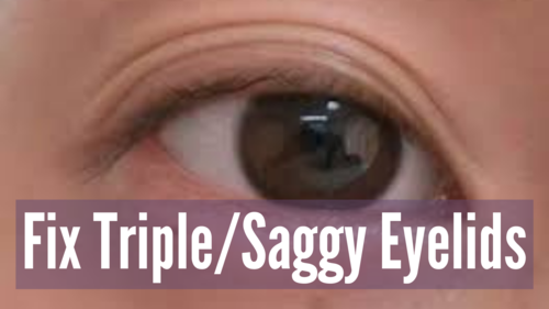 Fix Triple Eyelids