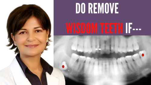 Thumbnail for 'Do Remove Wisdom Teeth If', outlining specific conditions and reasons when the removal of wisdom teeth is advisable for oral and facial health.