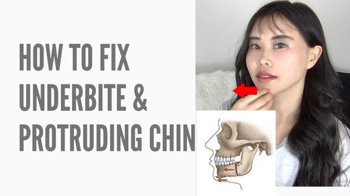 Video thumbnail depicting a woman touching her chin with a diagram illustrating the skeletal structure of an underbite and protruding chin, alongside text 'How to Fix Underbite & Protruding Chin.