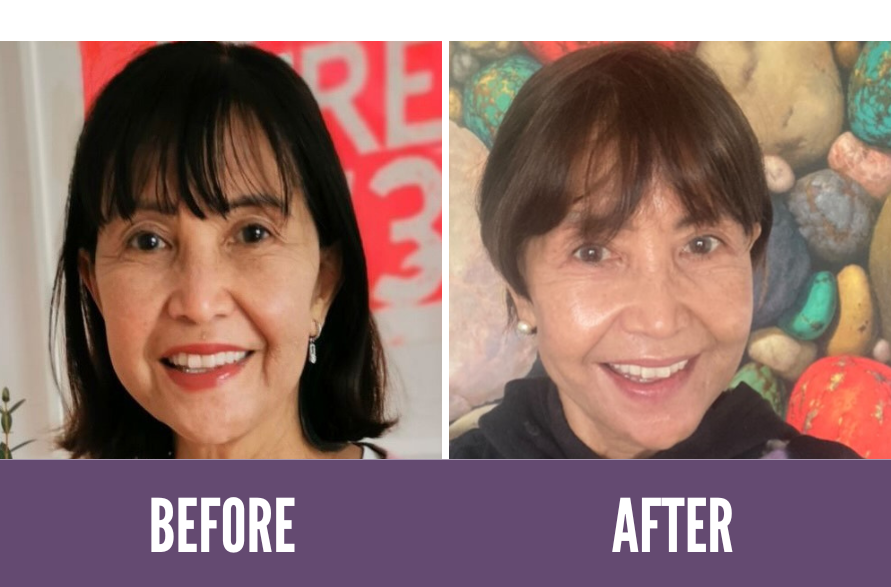 Before and After Koko Face Yoga