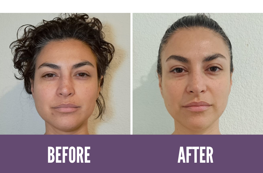 Before and After Koko Face Yoga