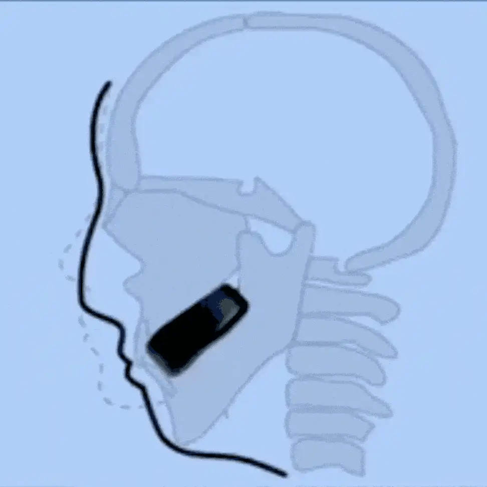 A simple line drawing on a light blue background showing a side profile of a head and neck with a black rectangular device placed inside the mouth area.

