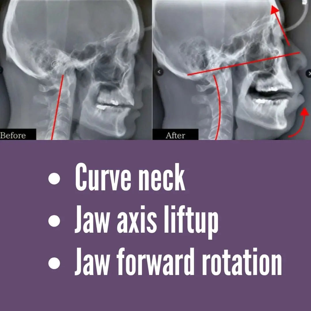 Facial Aligner Slide showing before and after X-rays with improved neck curve, jaw axis lift, and forward jaw rotation from Koko Face Yoga.