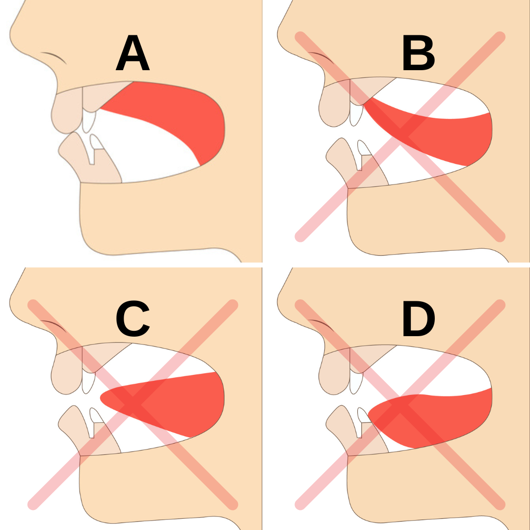 correct tongue posture