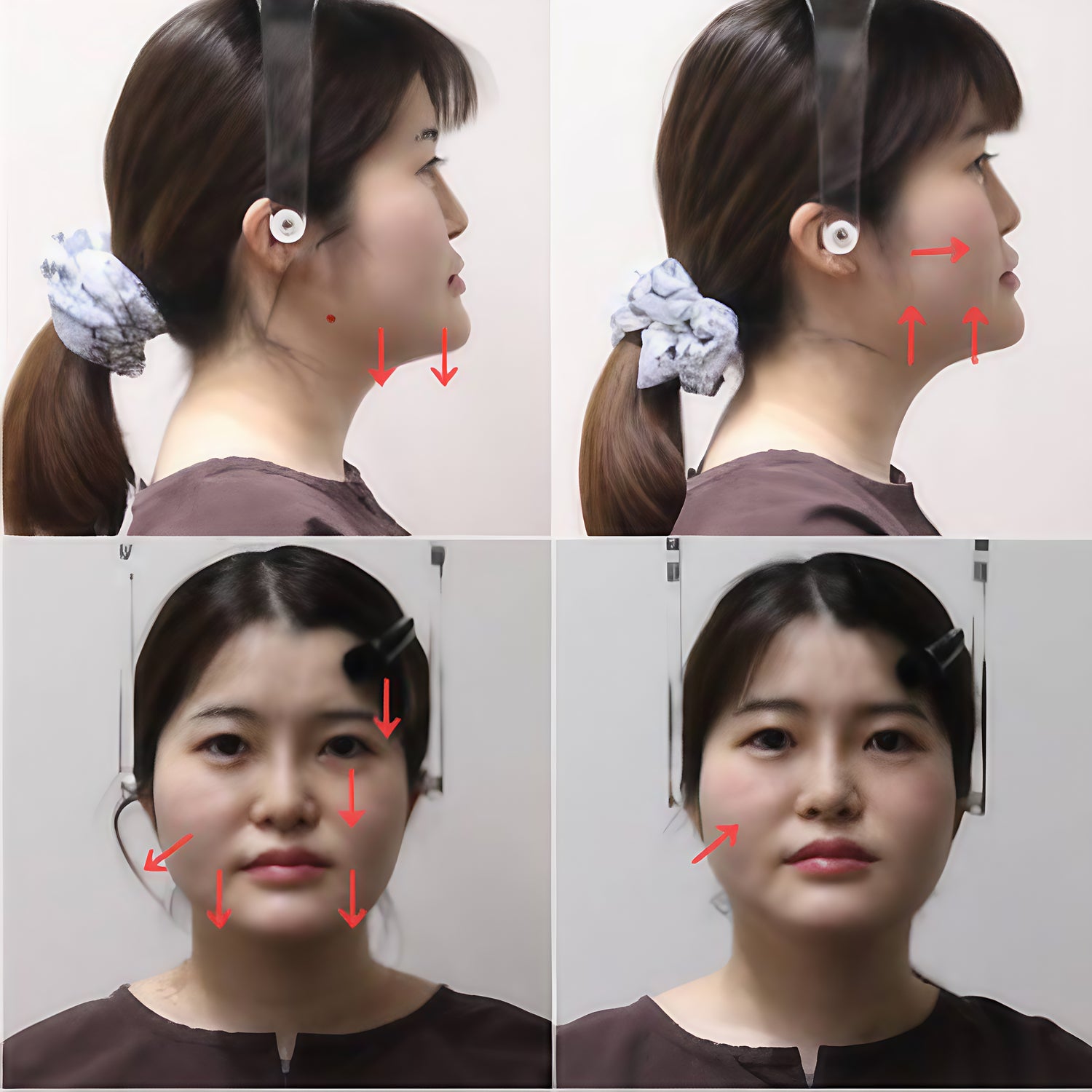 Before and after images showing improved face posture and lifted jawline using facial aligner.