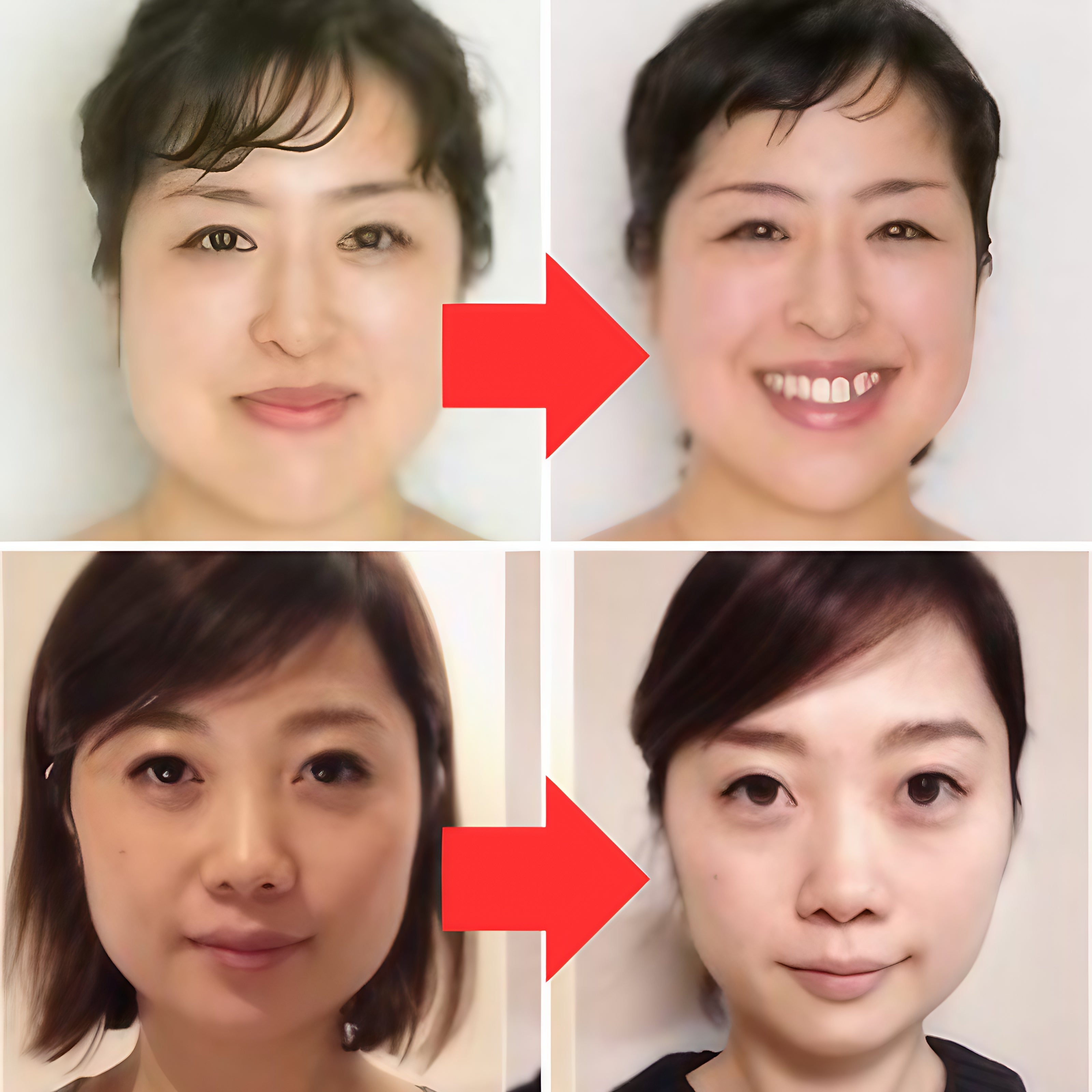 Before and after facial transformation photos showing the effects of using the Facial Aligner.
