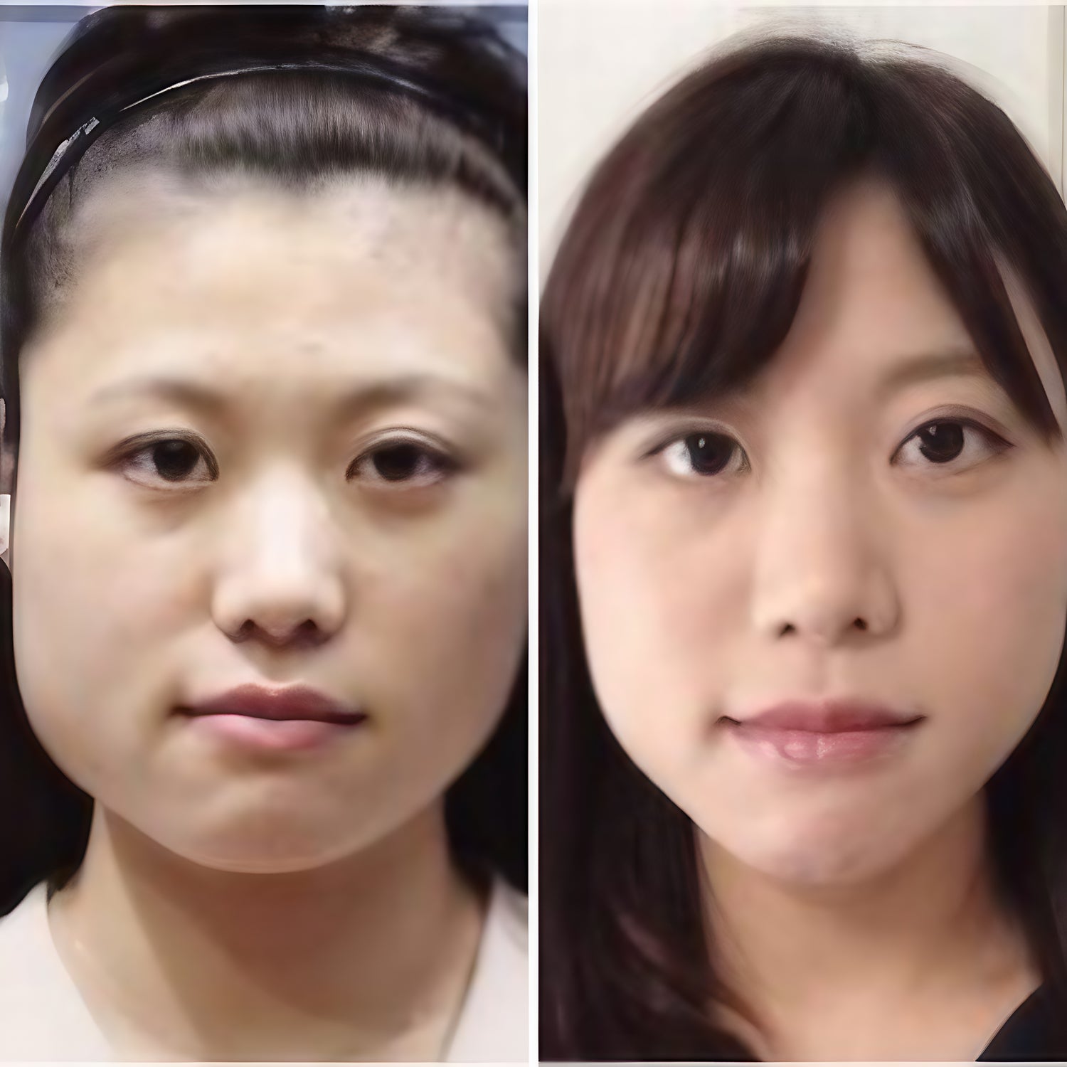 Before and after facial transformation photos showing the effects of using the Facial Aligner.