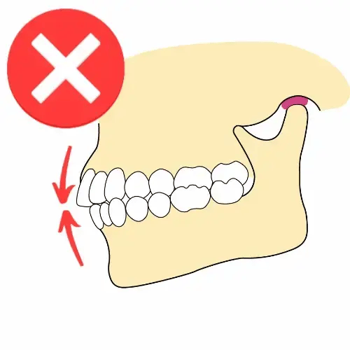 A simple diagram showing a side profile of a jaw with teeth, red arrows indicating movement, and a red circle with a white X marking, likely illustrating an incorrect or undesirable dental/orthodontic position.

