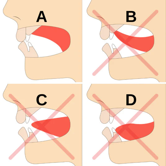 Tongue_Posture_1