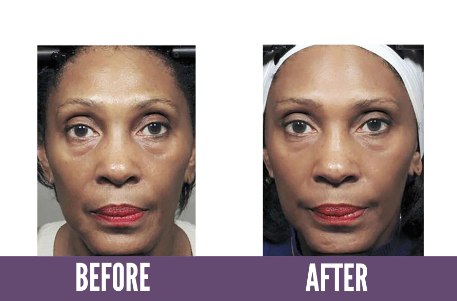 Before and after photos showing the results of Koko Face Yoga on a woman, highlighting a more radiant complexion and improved skin tone, demonstrating the effectiveness of the face yoga techniques.