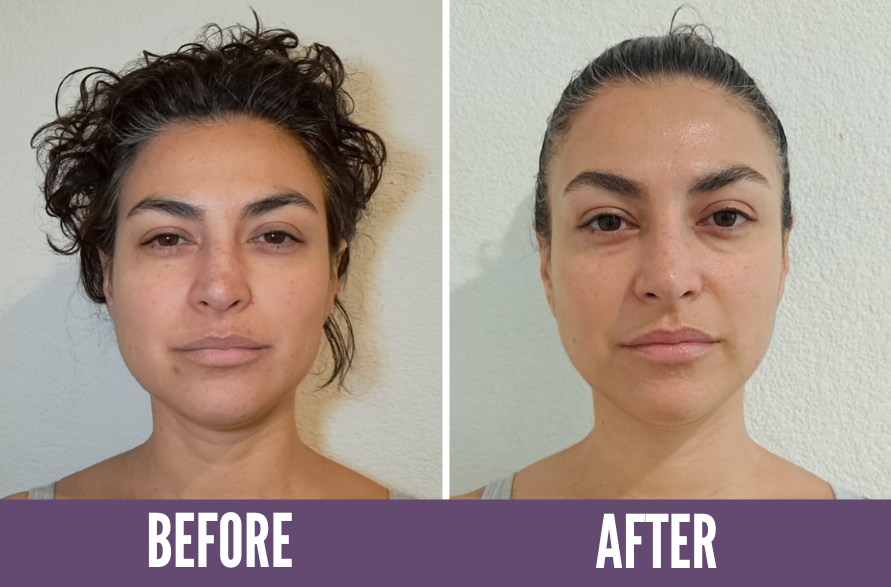 Before and after photos showing the results of Koko Face Yoga on a woman, highlighting a more radiant complexion and improved skin tone, demonstrating the effectiveness of the face yoga techniques.