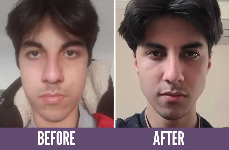 More defined jaw line after face yoga