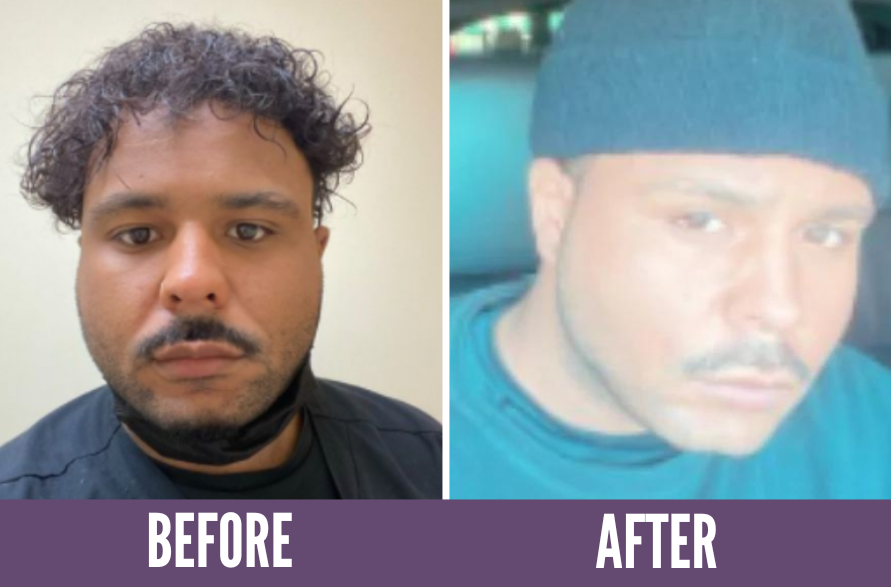 Before and after photos showing the results of Koko Face Yoga on a woman, highlighting a more radiant complexion and improved skin tone, demonstrating the effectiveness of the face yoga techniques.