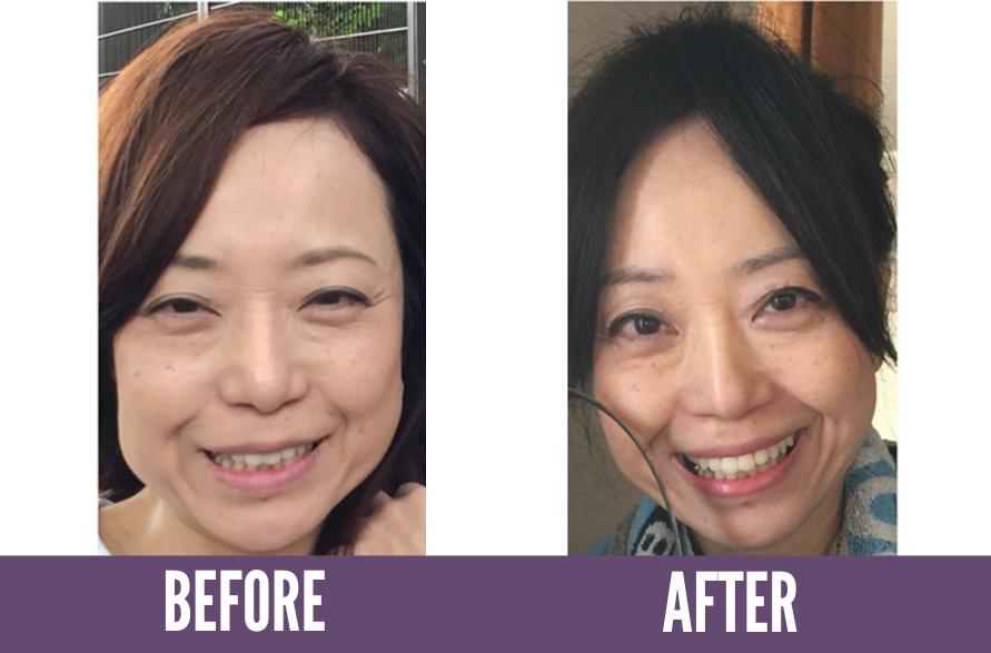 Before After Koko Face Yoga
