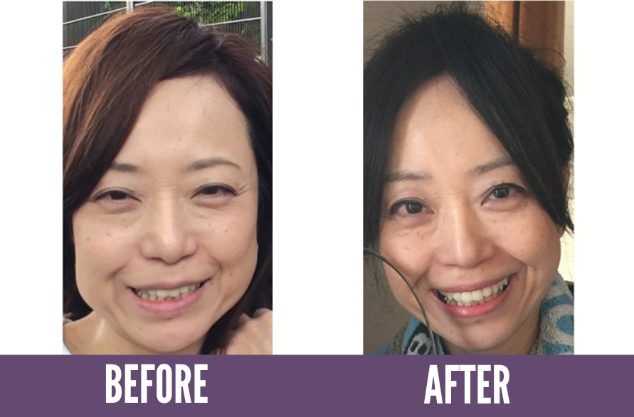 Before and after photos showing the results of Koko Face Yoga on a woman, highlighting a more radiant complexion and improved skin tone, demonstrating the effectiveness of the face yoga techniques.