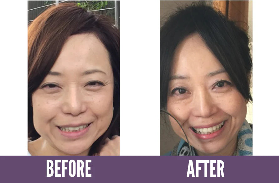 Face Yoga difference after 1 year