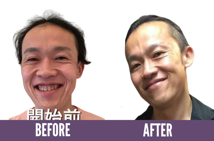 Before and after photos showing the results of Koko Face Yoga on a woman, highlighting a more radiant complexion and improved skin tone, demonstrating the effectiveness of the face yoga techniques.