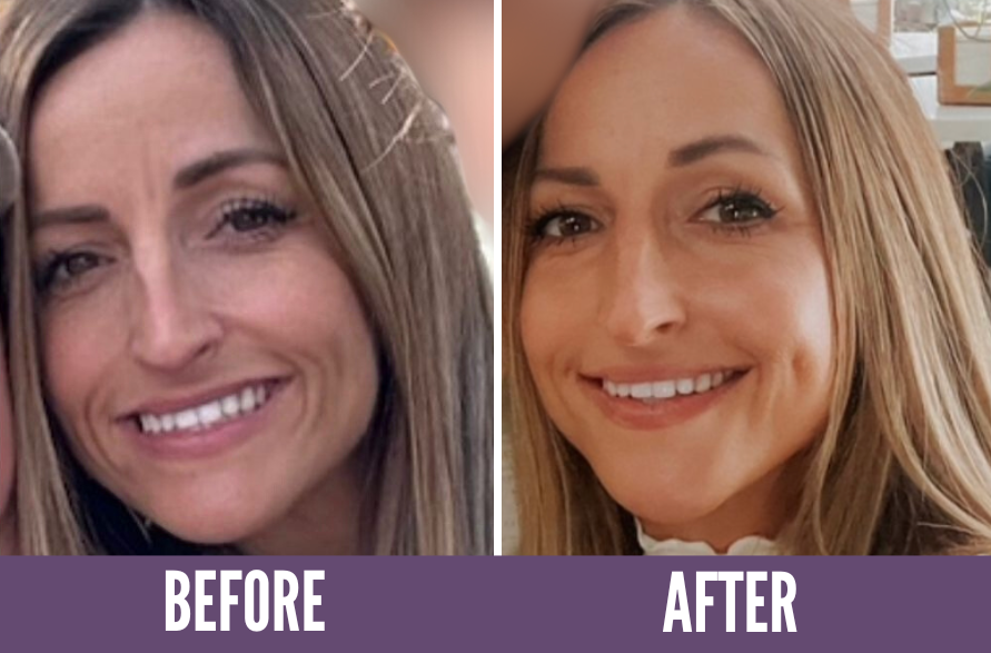 Before After Koko Face Yoga